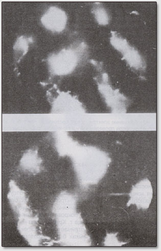 Фото 8. Электрическое состояние кожи подушки пальца С.Д.Кирлиан до лечебной процедуры (вверху) и после нее (внизу) (увеличено в 500 раз). Авторы - супруги Кирлиан.