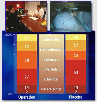 Исследования плацебо-эффекта при спаечных операциях проводится голландским хирургом Дингеманом Сванком (Dingeman Swank)